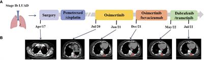 Case Report: Lung adenocarcinoma associated with germline ERCC2 frameshift mutation